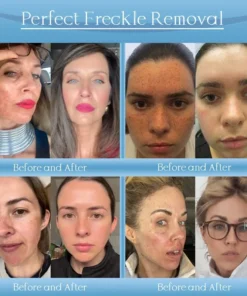 𝐉𝐨𝐫𝐨𝐧𝐝𝐲® Age-Defying Lifting Serum - Remove Wrinkles, Firms Skin, Whitening