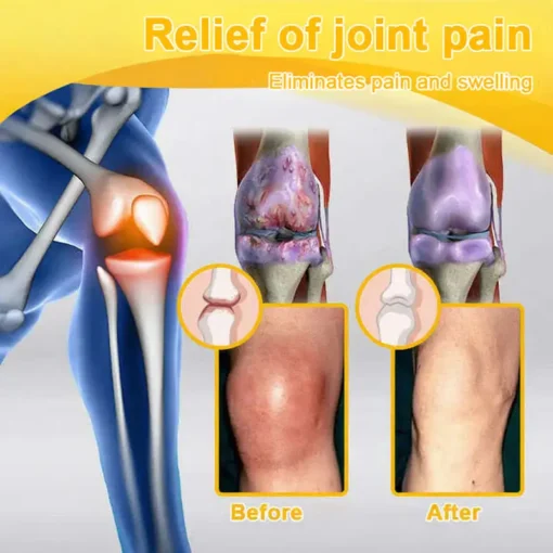 Jorondy® Bee Venom Pain-Relief Bone Healing Spray