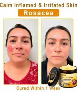 Jorondy® Skin Treatment Cream