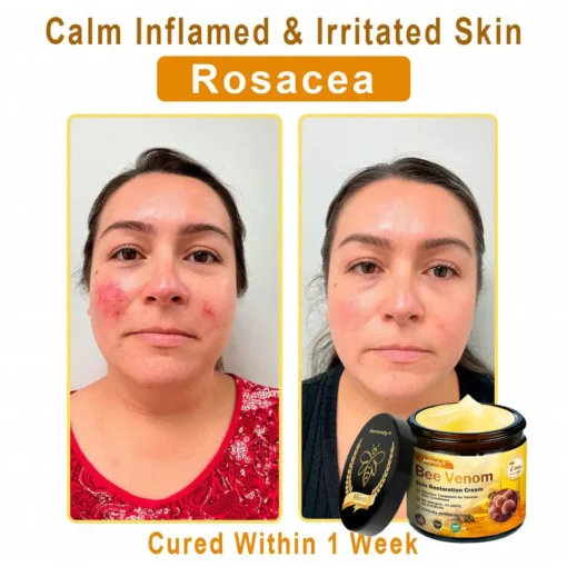 Jorondy® Skin Treatment Cream