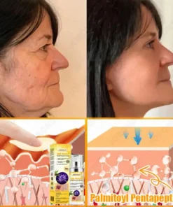 JORONDY® Bee Venom Senile Purpura Cream