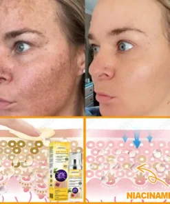 JORONDY® Bee Venom Senile Purpura Cream