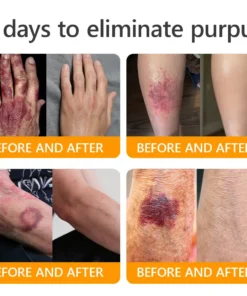 JORONDY® Bee Venom Senile Purpura Cream