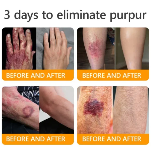 JORONDY® Bee Venom Senile Purpura Cream