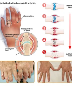 Jorondy® Bee Venom Pain-Relief Bone Healing roll-on-On